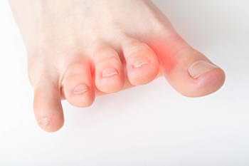 Is Morton’s Neuroma a Type of Cancer?