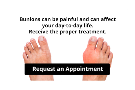  Are Bunions Affecting Your Everyday Life? 