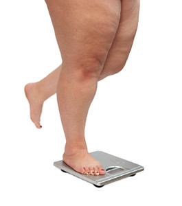 Obesity and Plantar Fasciitis model