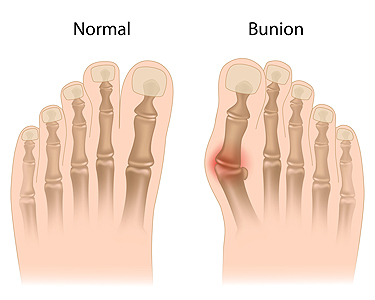 Infographic depicting X-Ray of how Bunions affect the foot