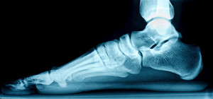 X-Ray of flat foot