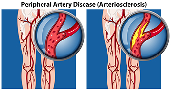 Peripheral Artery Disease infographic