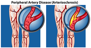  Is It Peripheral Artery Disease, or Something Else? 