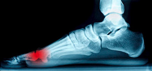 X-Ray of Sesamoid Bones