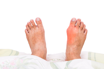 How Common Are Bunions?