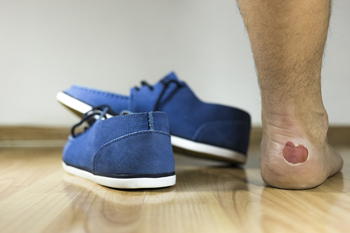 Patient with Blisters on the Feet