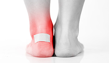 Why Foot Blisters Can Develop