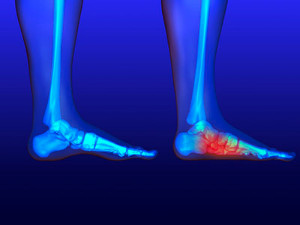 Infographic depicting patient with Flat Feet