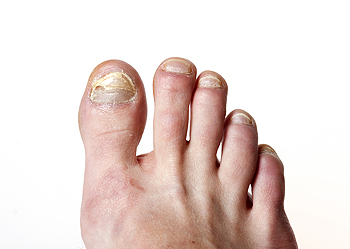 Patient with Toenail Fungus