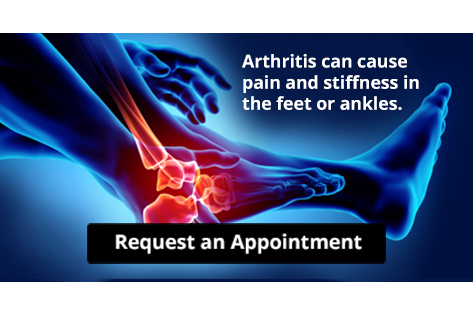 Arthritis in the Feet and Ankles infographic