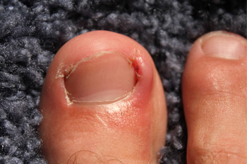 Patient with an Ingrown Toenail