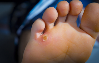 Patient with Corns on the Feet