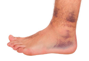 Ankle Sprain patient with bruises