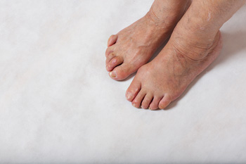 The Types of Hammertoes