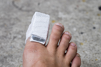Why a Podiatrist Should Look at Your Broken Toe