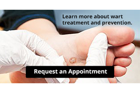 Plantar Warts infographic