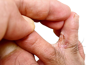  What to Do if You Have Athlete’s Foot 