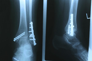 X-Rau of Different Types of Fractures