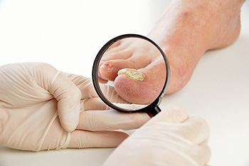 Doctor with patient that has Toenail Fungus