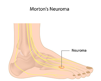 Morton’s Neuroma infographic depicting a foot and where the neuroma would be