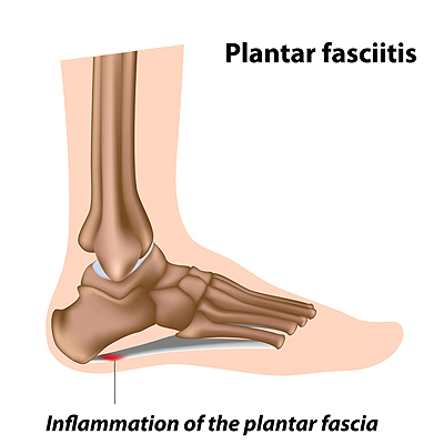 Plantar Fasciitis infographic showing pain on the heel