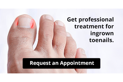 Ingrown Toenail infographic