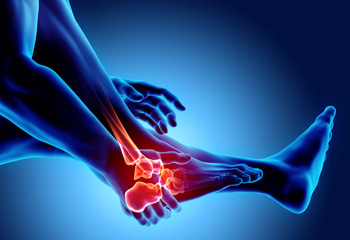 Types of Foot Ulcers