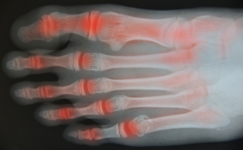 X-Ray depicting Rheumatoid Arthritis patients foot