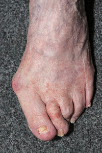 Bunions model