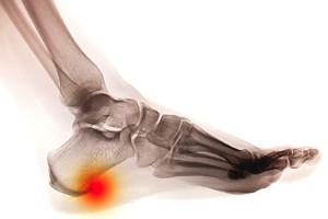 Understanding the Basics of Heel Pain