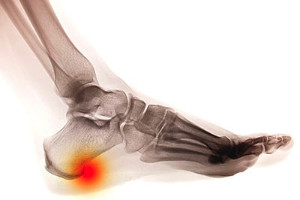  Understanding the Basics of Heel Pain 