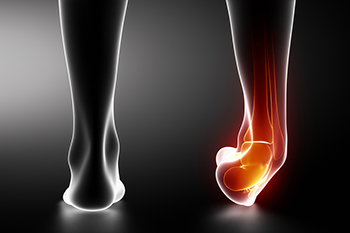  Effects of a Peroneus Brevis Tendon Injury 